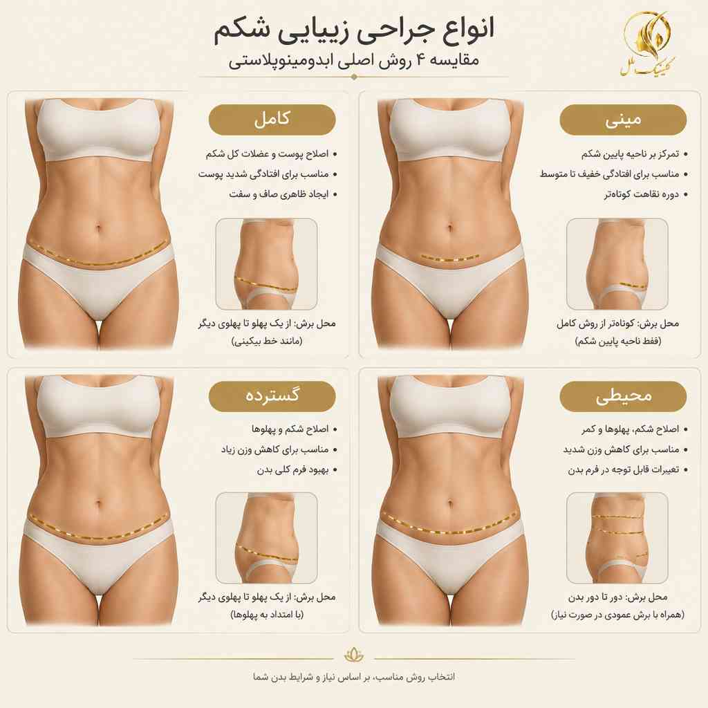 مقایسه انواع ابدومینوپلاستی کامل، مینی، گسترده و محیطی