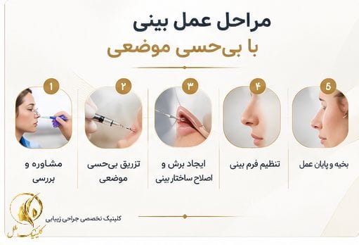 مراحل عمل بینی با بی&zwnj;حسی موضعی
