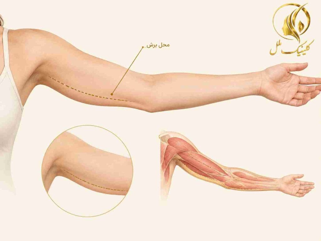 brachioplasty01 براکیوپلاستی و محل برداشتن پوست اضافه بازو