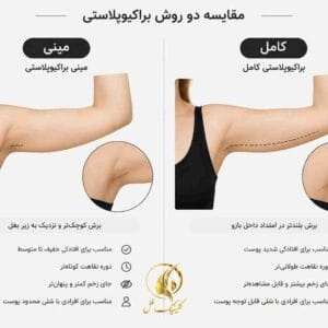 مقایسه انواع روشهای براکیوپلاستی