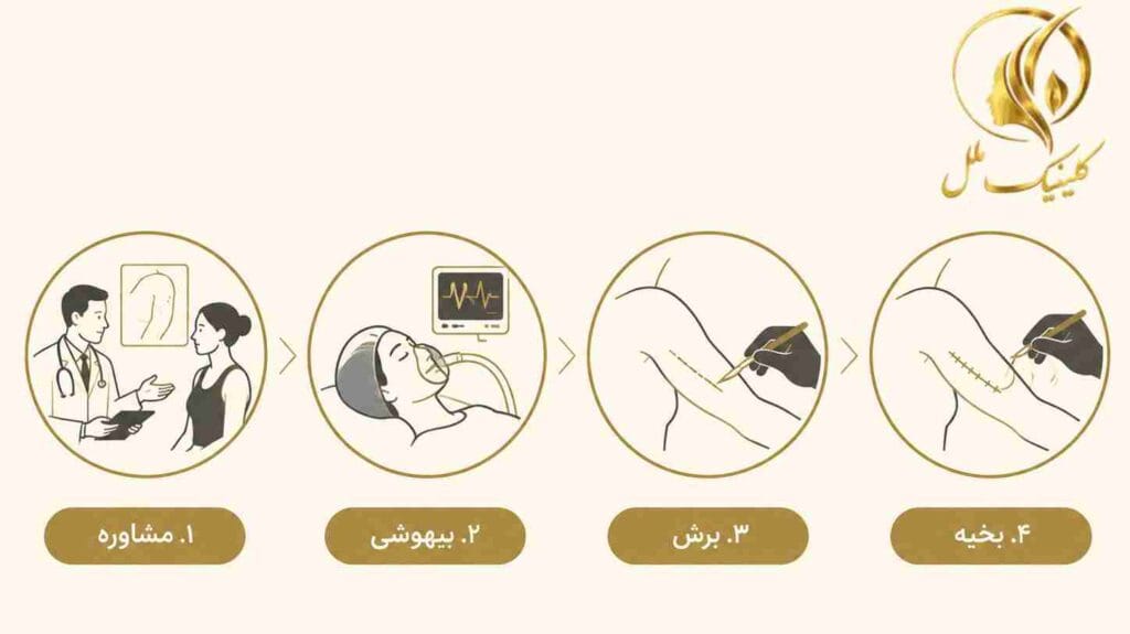 brachioplasty03 مراحل جراحی لیفت بازو