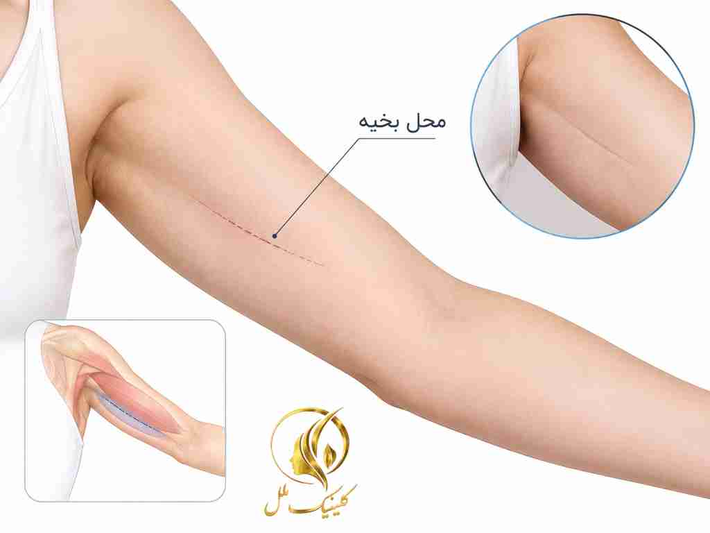 brachioplasty04 محل برش و جای زخم جراحی لیفت بازو