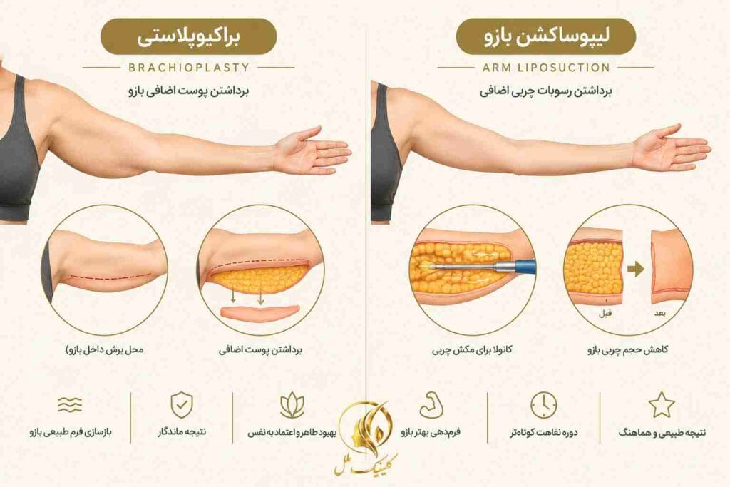 brachioplasty05 مقایسه براکیوپلاستی و لیپوساکشن بازو