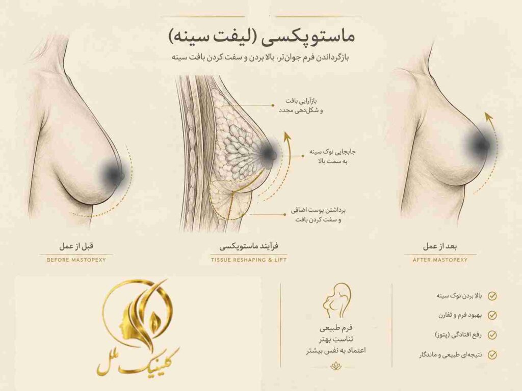breast-lift01 لیفت سینه یا ماستوپکسی برای اصلاح افتادگی سینه