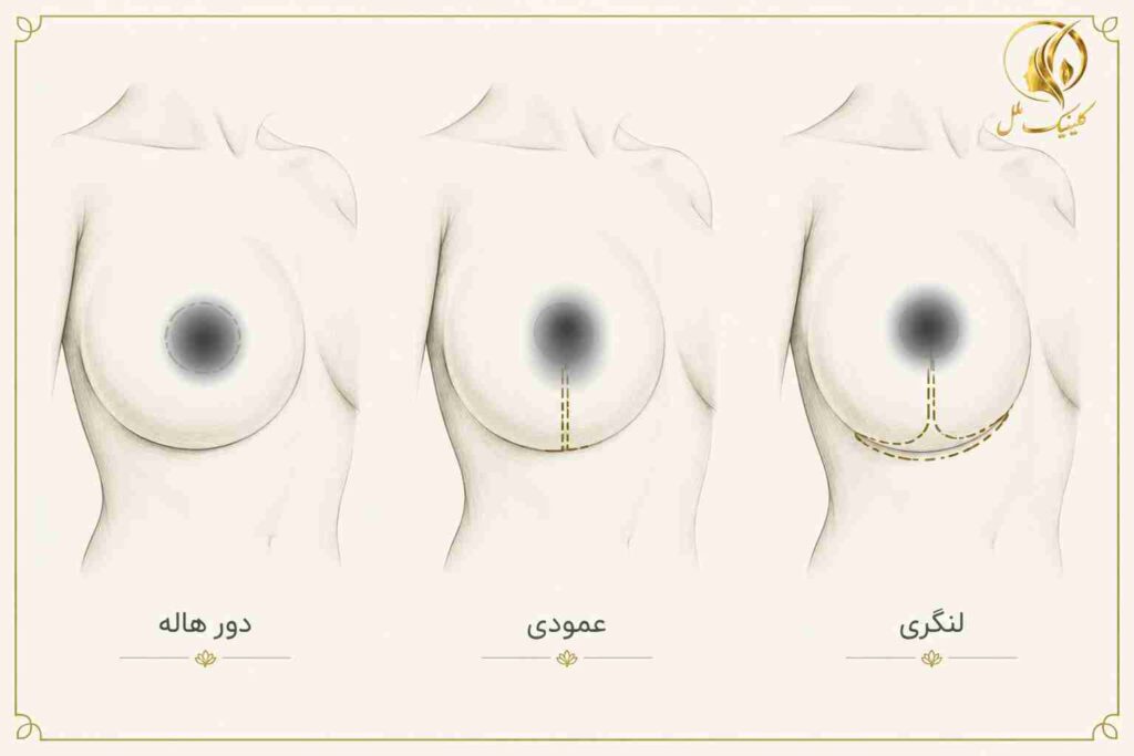 breast-lift03 انواع برش در جراحی لیفت سینه