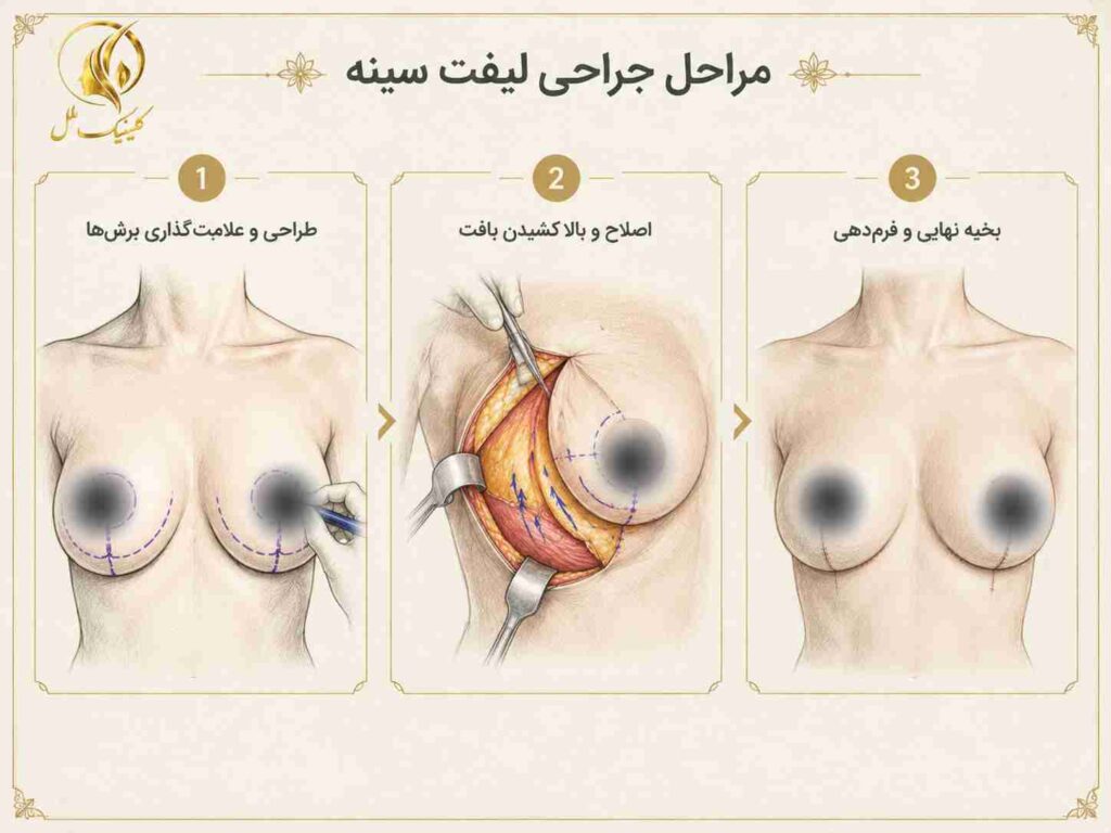 breast-lift04 مراحل اصلی جراحی لیفت سینه