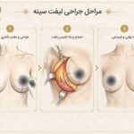 مراحل اصلی جراحی لیفت سینه