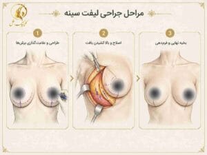 مراحل اصلی جراحی لیفت سینه