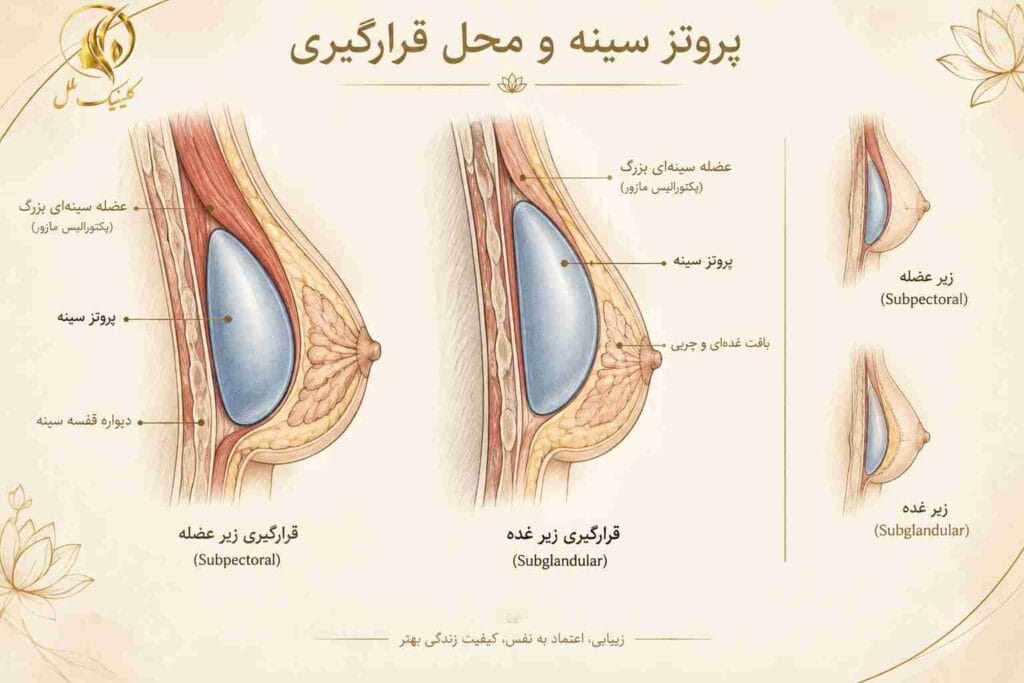پروتز سینه چیست و ایمپلنت سینه چگونه قرار می&zwnj;گیرد