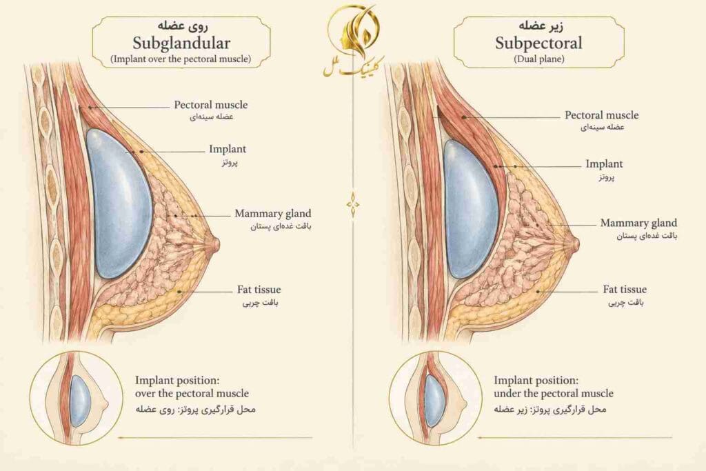 محل قرارگیری پروتز سینه زیر عضله و روی عضله