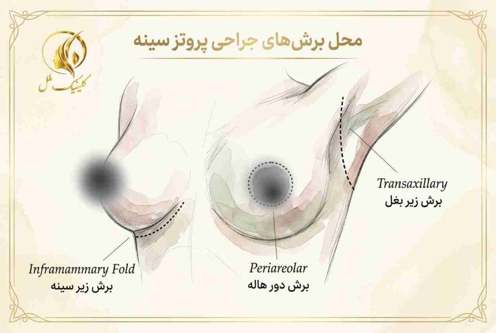 محل برش&zwnj;های جراحی پروتز سینه