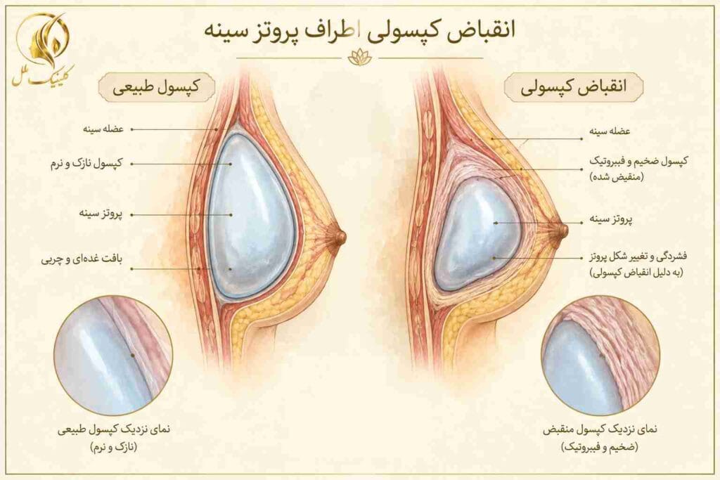 انقباض کپسولی اطراف پروتز سینه