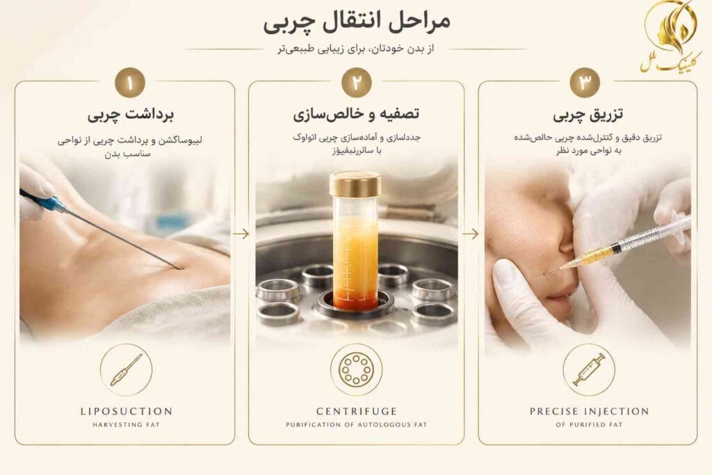 lipo-transfer02 مراحل BBL از برداشت تا تزریق چربی