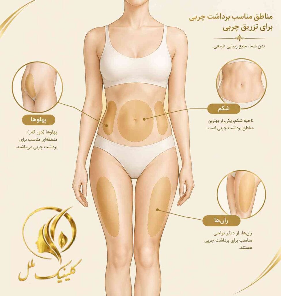 lipo-transfer03 نواحی مناسب برداشت چربی برای ترانسفر به باسن