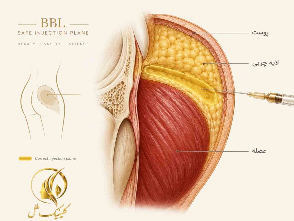 lipo-transfer06 لایههای بافت باسن و اهمیت محل تزریق چربی در BBL