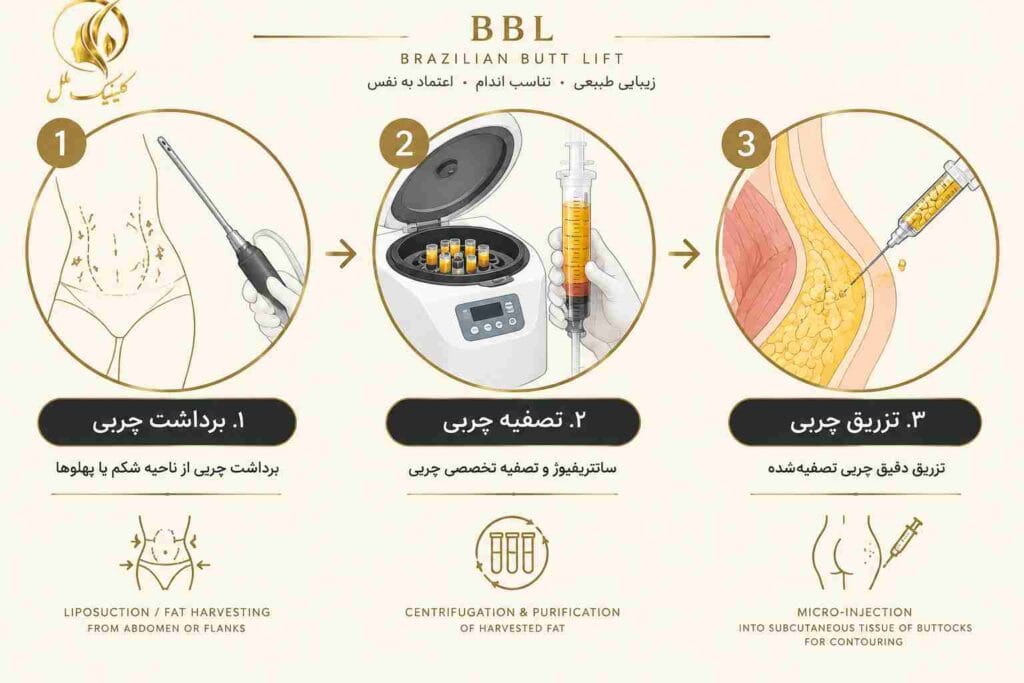 lipo-transfer08 مراحل لیپو ترانسفر از برداشت تا تزریق چربی به باسن