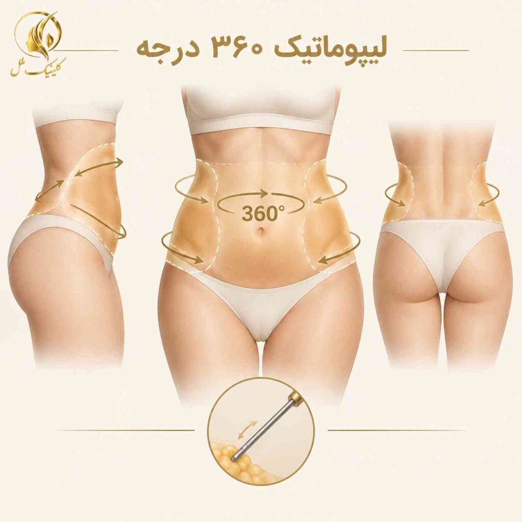 لیپوماتیک ۳۶۰ درجه و نواحی تحت درمان در میان تنه