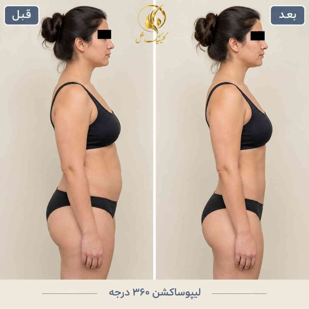 قبل و بعد لیپو 360