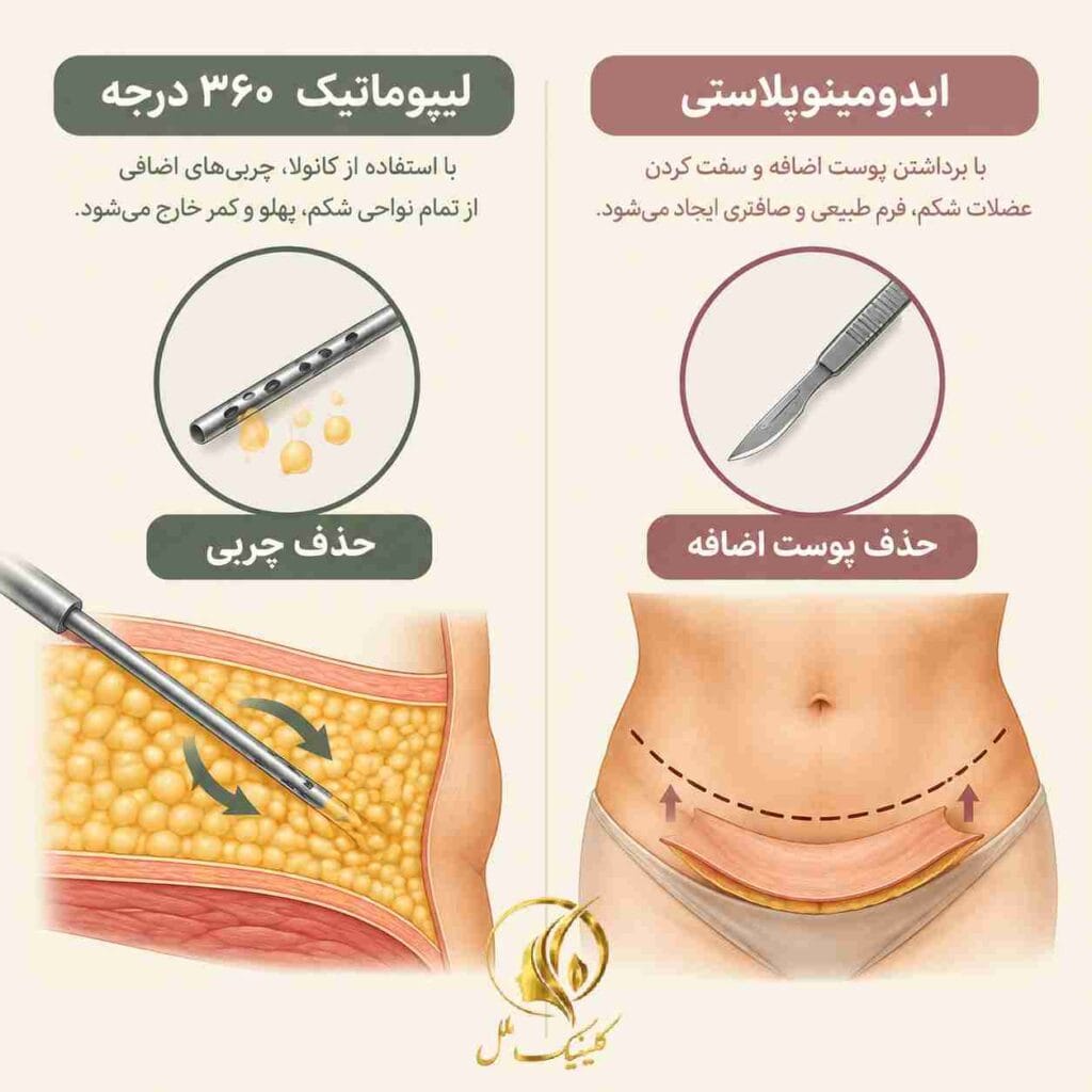 فرق لیپو 360 با ابدومینوپلاستی