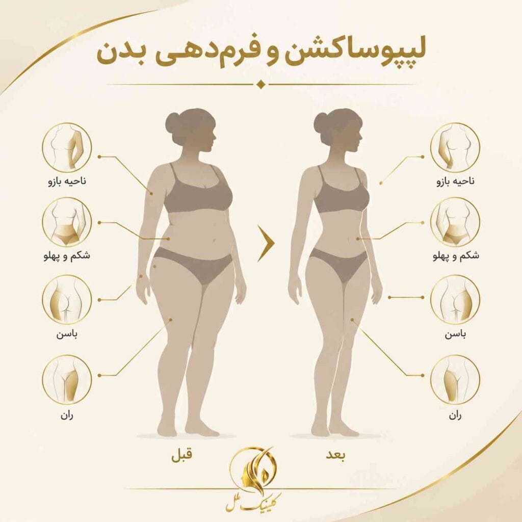 liposuction-surgery01 لیپوساکشن و فرمدهی بدن