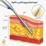 نحوه انجام لیپوساکشن با کانولا
