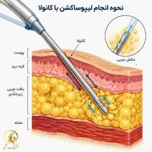 نحوه انجام لیپوساکشن با کانولا