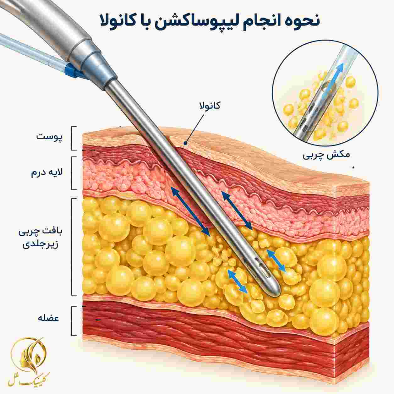 liposuction-surgery02 نحوه انجام لیپوساکشن با کانولا