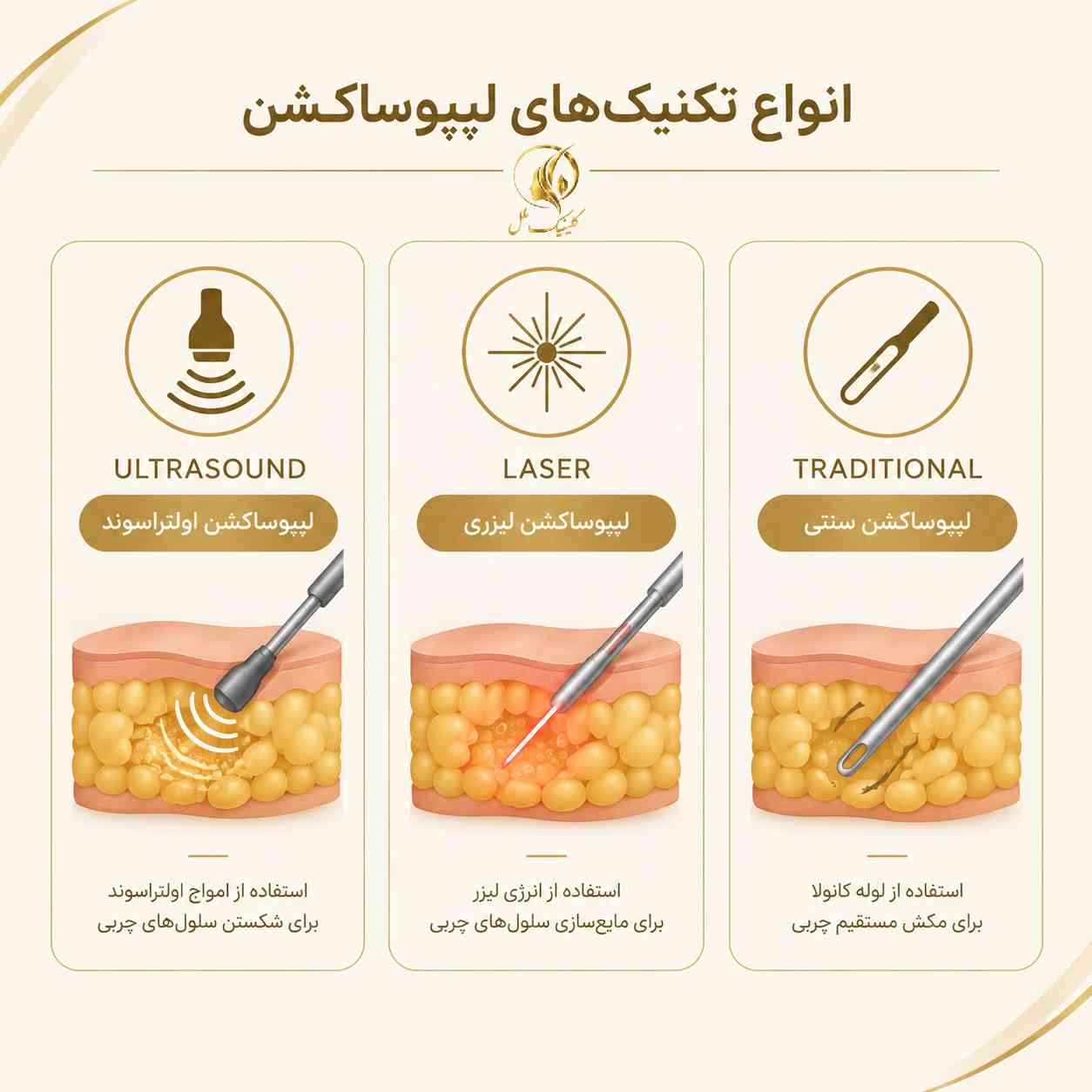 liposuction-surgery03 انواع تکنیکهای لیپوساکشن