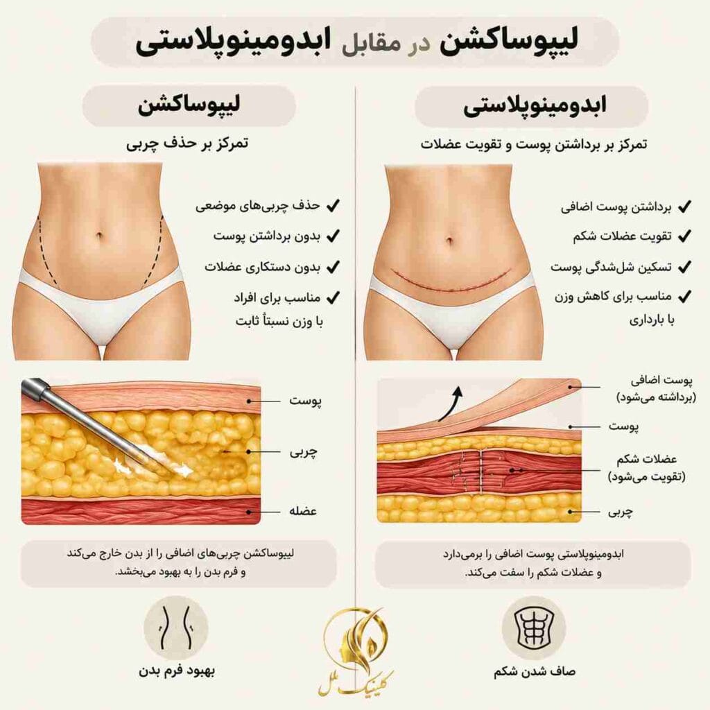 liposuction-surgery06 تفاوت لیپوساکشن و ابدومینوپلاستی