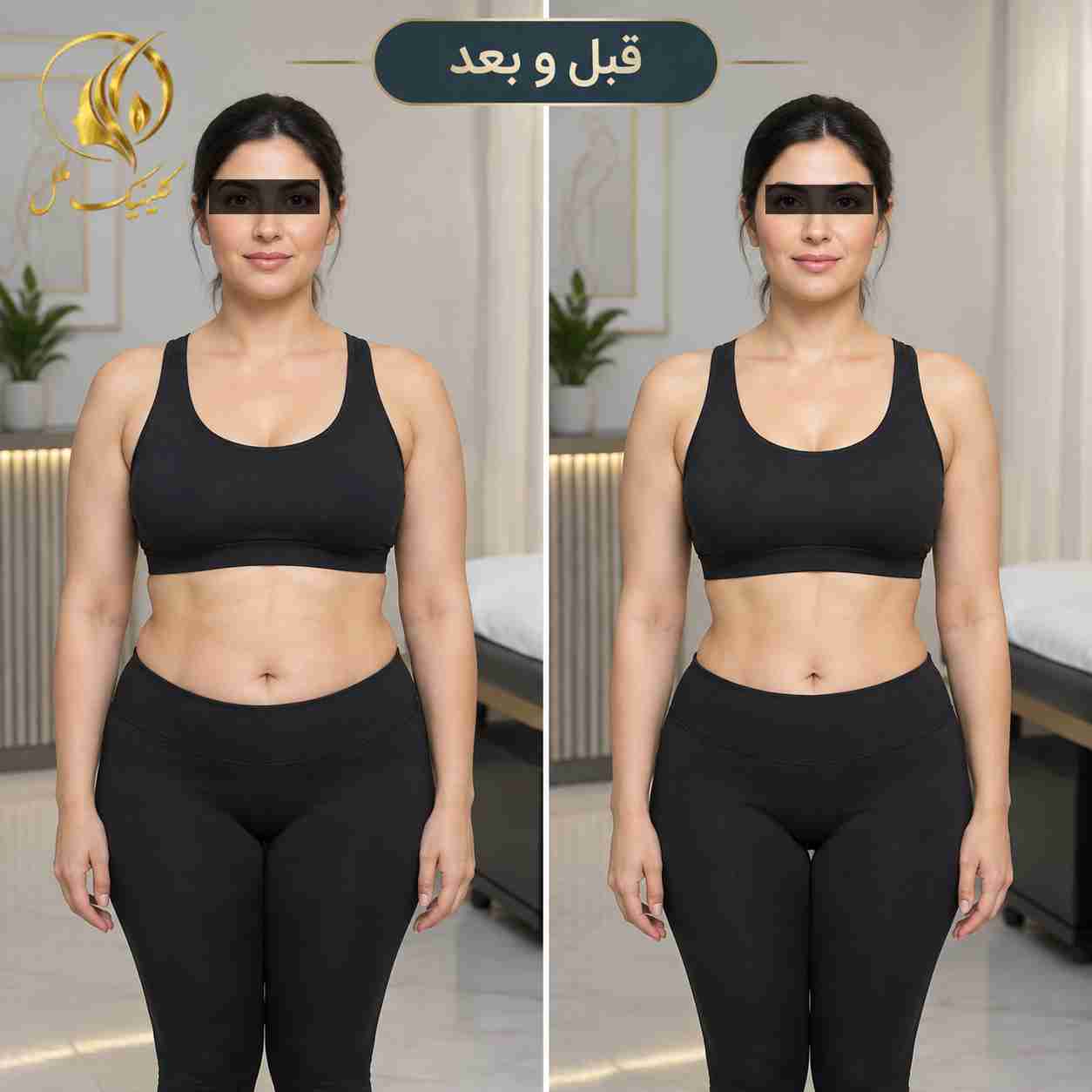 liposuction-surgery07 نتایج لیپوساکشن و فرمدهی بدن