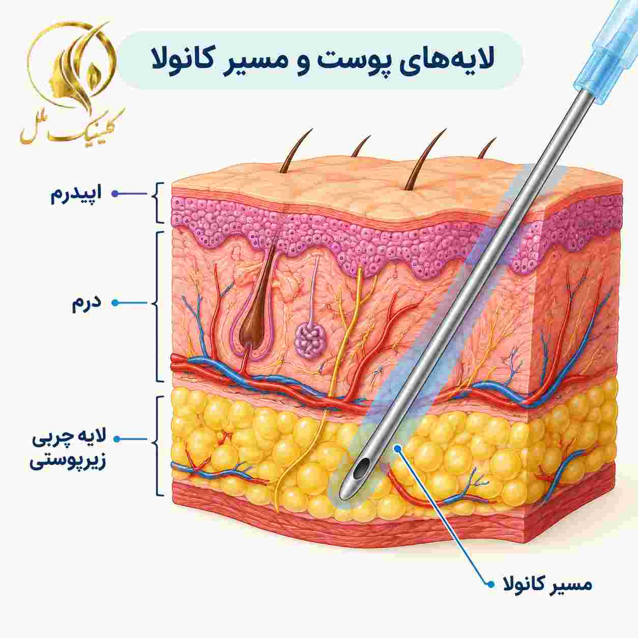 liposuction-surgery08 نمای شماتیک لایههای پوست و چربی زیرپوستی و مسیر ورود کانولا در عمل لیپوساکشن