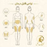 نقشه&zwnj;ی نواحی رایج لیپوساکشن شامل شکم، پهلو، ران، بازو و غبغب