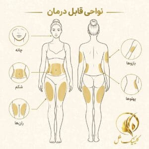 نقشهی نواحی رایج لیپوساکشن شامل شکم، پهلو، ران، بازو و غبغب