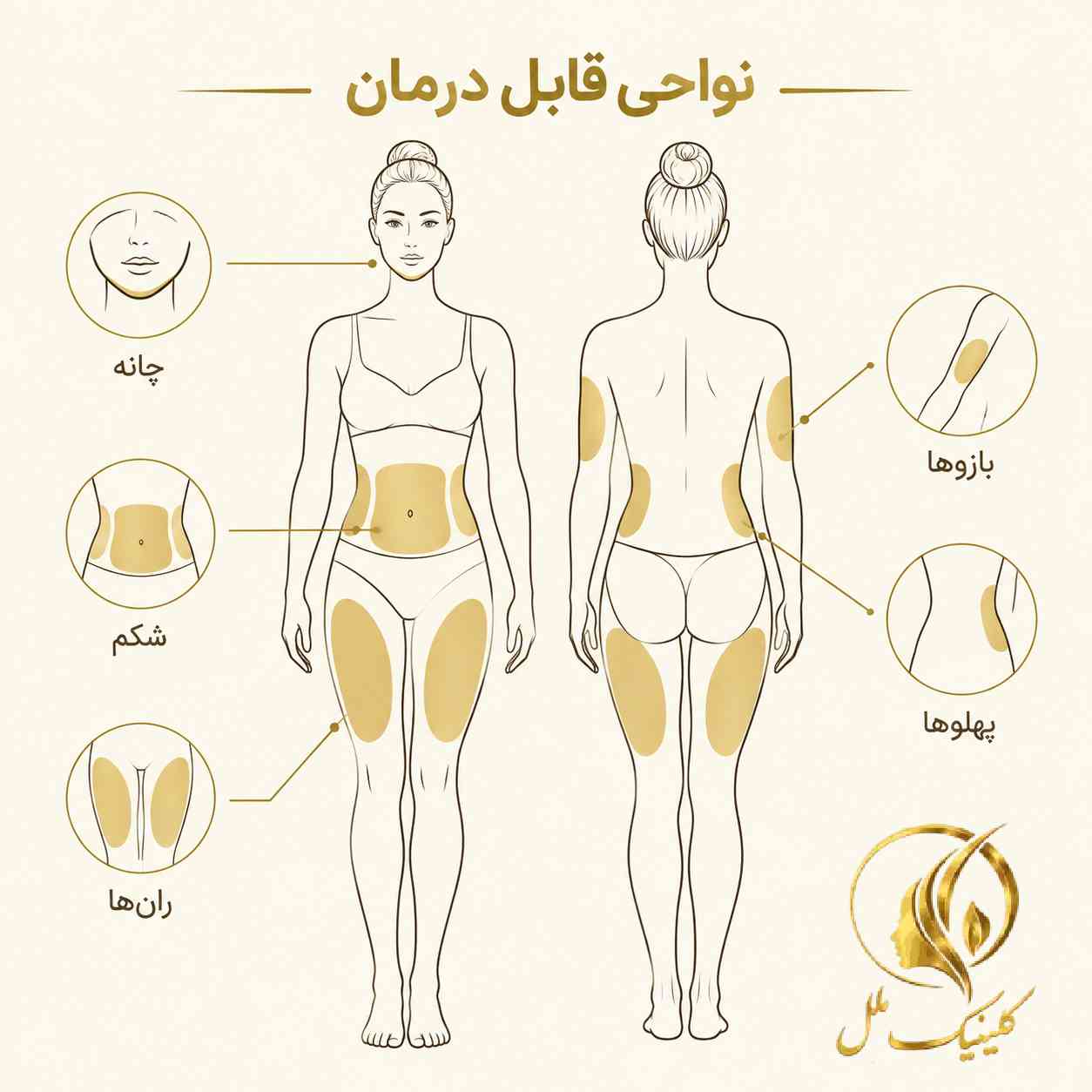 جراحی زیبایی بدن؛ انواع، روشها، هزینه و عوارض نقشهی نواحی رایج لیپوساکشن شامل شکم، پهلو، ران، بازو و غبغب