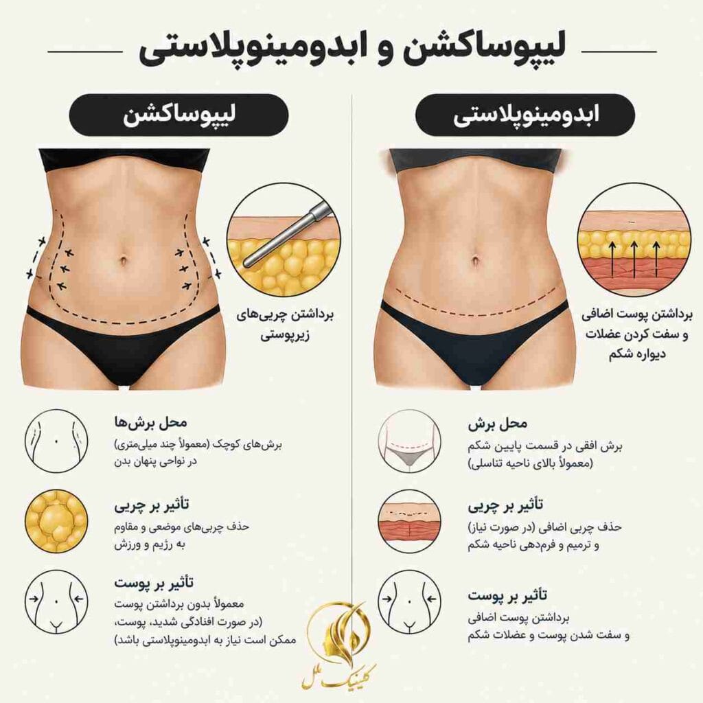 liposuction-surgery13 مقایسهی محل برش و ناحیهی درمان در لیپوساکشن و ابدومینوپلاستی