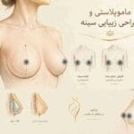ماموپلاستی و جراحی زیبایی سینه