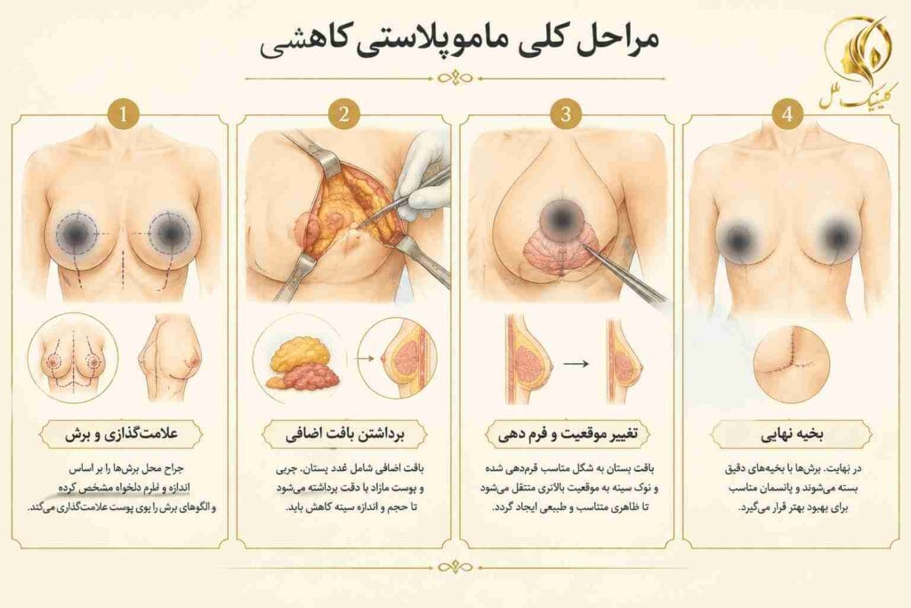 mammoplasty04 مراحل کلی ماموپلاستی کاهشی