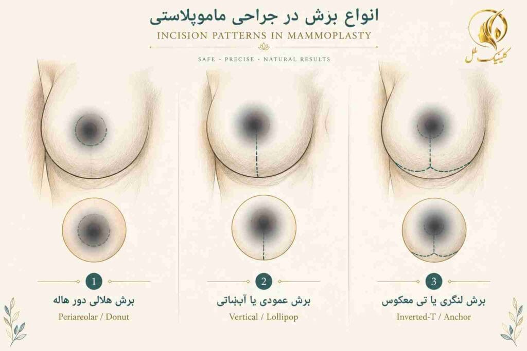 mammoplasty08 انواع برش در جراحی ماموپلاستی