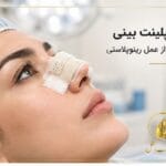 اسپلینت بینی بعد از عمل رینوپلاستی