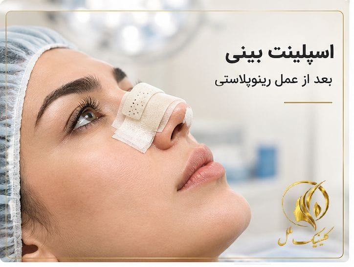 اسپلینت بینی بعد از عمل رینوپلاستی