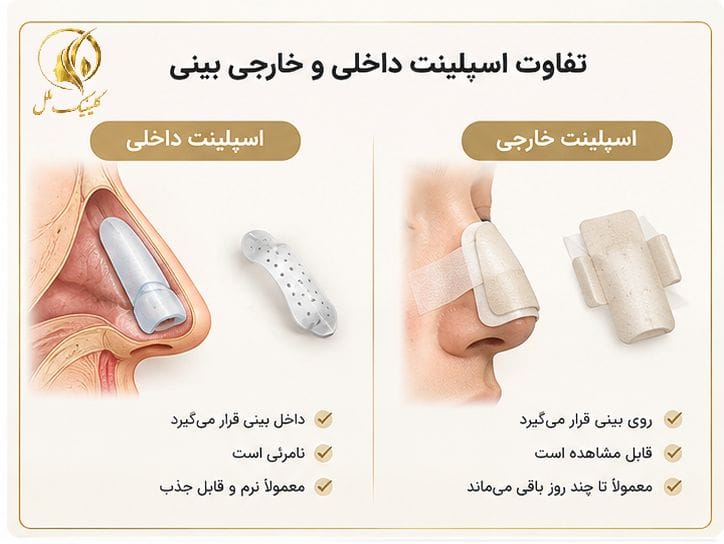 تفاوت اسپلینت داخلی و خارجی بینی