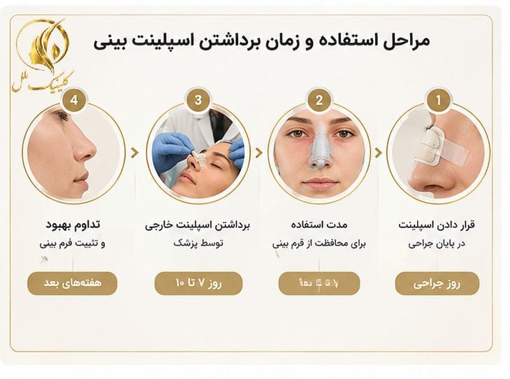 مراحل استفاده و زمان برداشتن اسپلینت بینی