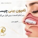 تامپون بینی چیست و در کدام قسمت بینی قرار می&zwnj;گیرد
