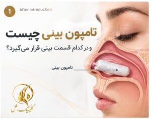 تامپون بینی چیست و در کدام قسمت بینی قرار می&zwnj;گیرد