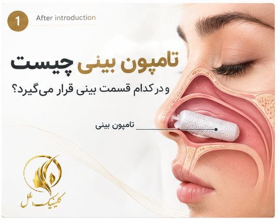 تامپون بینی چیست و در کدام قسمت بینی قرار می&zwnj;گیرد