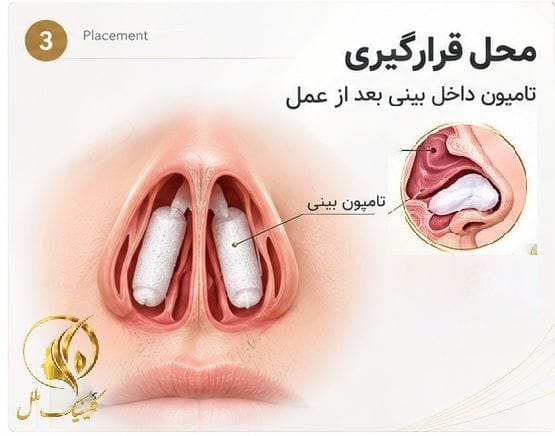 محل قرارگیری تامپون داخل بینی بعد از عمل