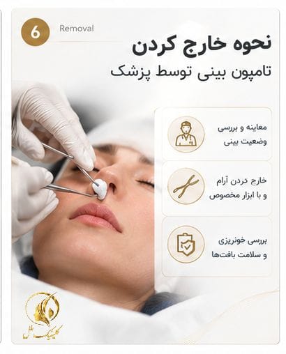 نحوه خارج کردن تامپون بینی توسط پزشک