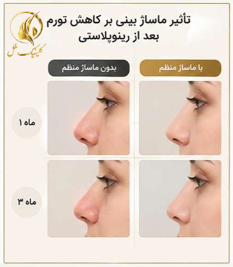 تأثیر ماساژ بینی بر کاهش تورم بعد از رینوپلاستی