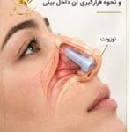 نوزونت بینی و نحوه قرارگیری آن داخل بینی