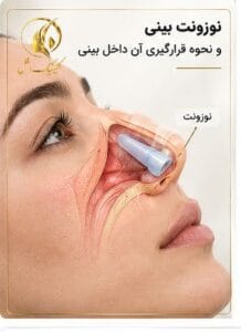 نوزونت بینی و نحوه قرارگیری آن داخل بینی